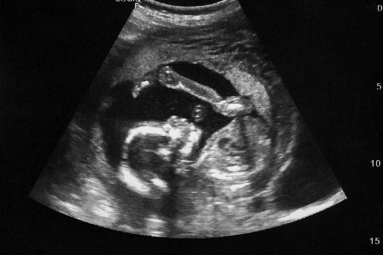 baby ultrasound at 12 weeks