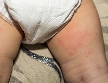 Mild nappy rash can be seen on a baby's upper leg.
